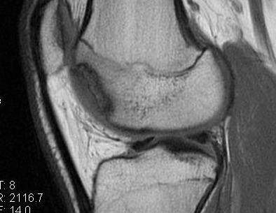 Femoral OCD Healing Before Drilling